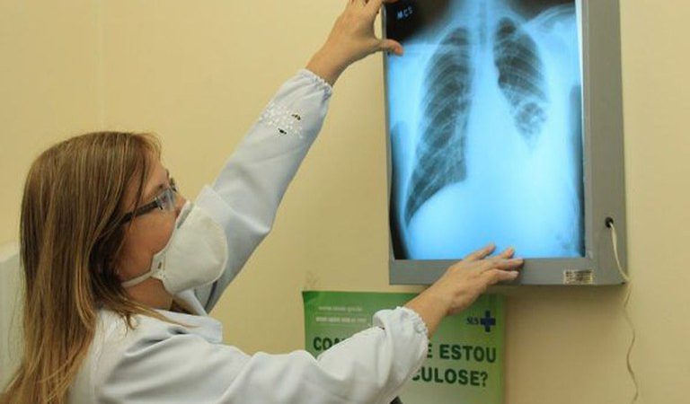 Mortes por tuberculose voltam a crescer no Brasil e no mundo